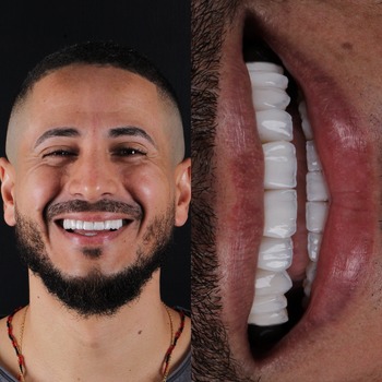 Especialista em Lente de Contato Dental em São Paulo Especialista em Lente de Contato Dental em São Paulo