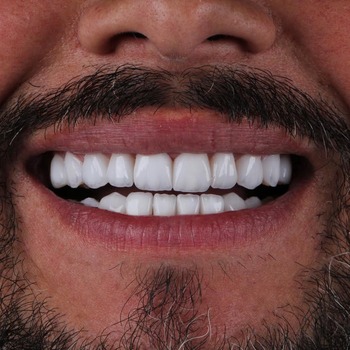 Especialistas em Lente de Contato Dental Especialistas em Lente de Contato Dental