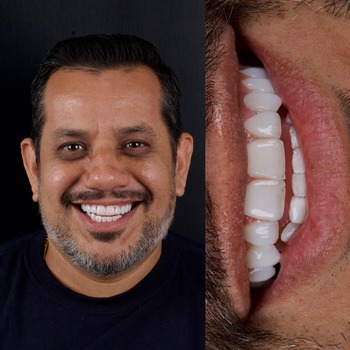 Estratificação em Resina Composta Estratificação em Resina Composta