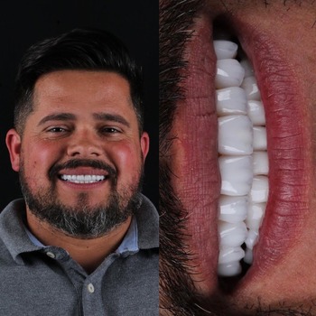 Facetas de Porcelana Preço Facetas de Porcelana Preço