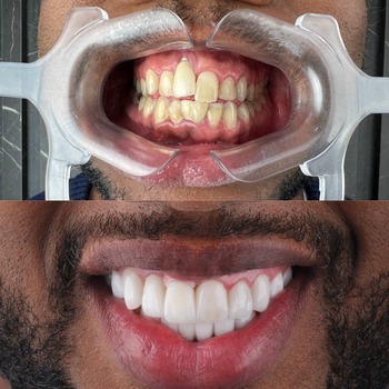 Implantes de Cerâmica Dentária Implantes de Cerâmica Dentária