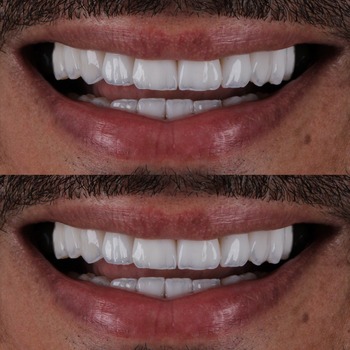 Lente de Contato Dental Lente de Contato Dental