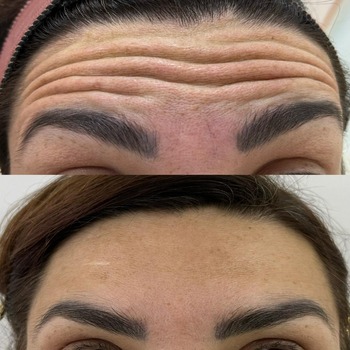 Preenchimento de Rugas Preenchimento de Rugas